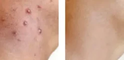 Skin Doctor s Ingrow Go gegen eingewachsene Haare Best