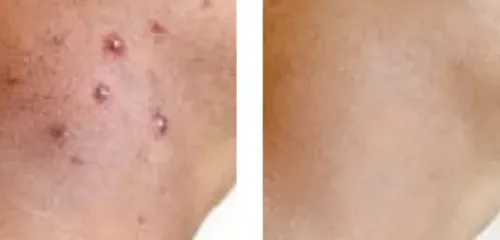 Skin Doctor s Ingrow Go gegen eingewachsene Haare Best